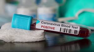 45 new cases testing positive for Coronavirus on Monday, June 8 in Udupi district